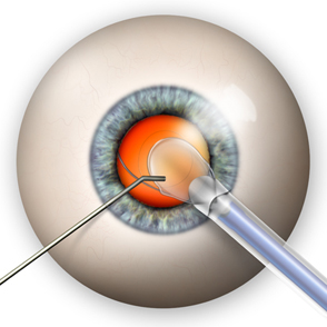 Cataractsurgery