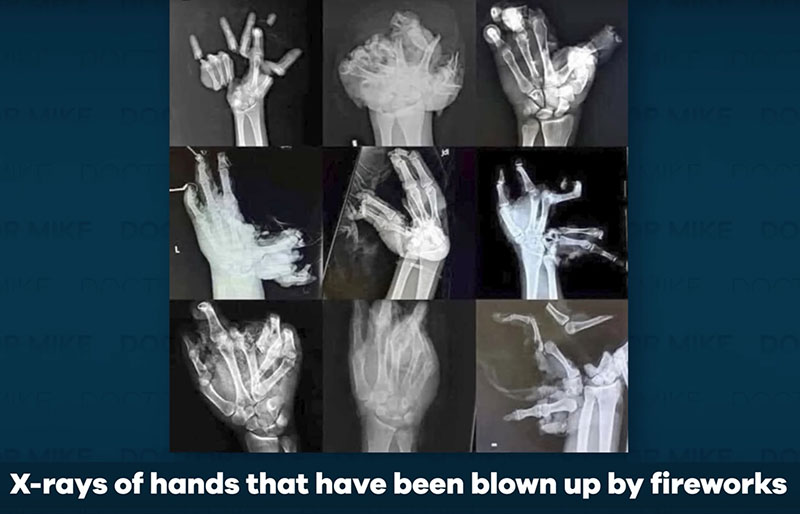 Bones